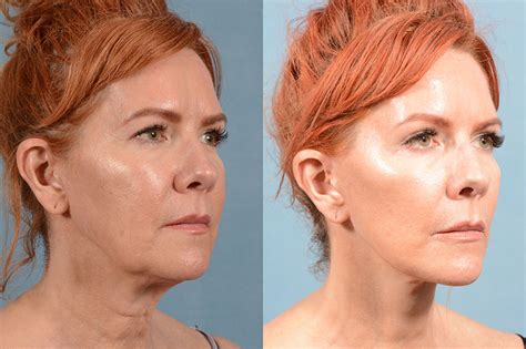 Microneedling Plasma Injections Hall Plastic Surgery Rejuvenation