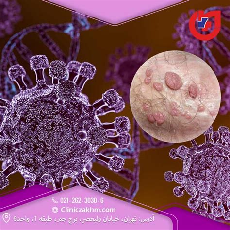 ویروس اچ پی وی چیست علائم و آزمایش hpv در مردان و زنان