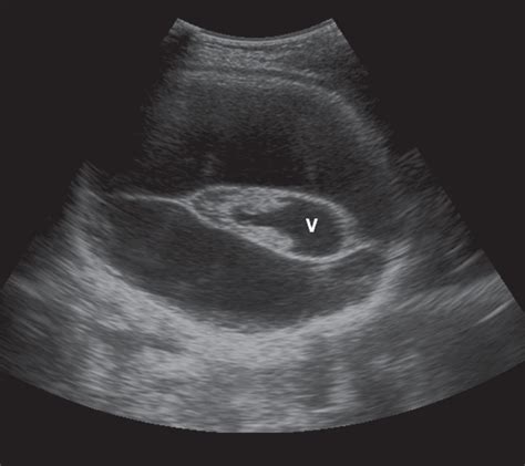 Hydranencephaly Ultrasound