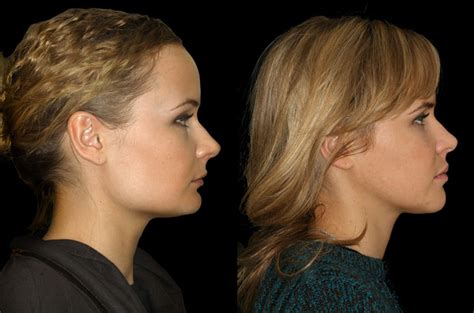 Orthognathic Facial Asymmetry Correction - Corrective Jaw Surgery - Dr ...