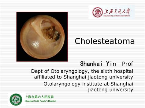 Ppt Cholesteatoma Powerpoint Presentation Free Download Id2957605