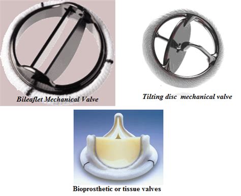 Mechanical Heart Valve