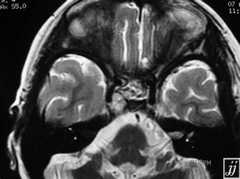 Right Parasellar Meningioma Radiopaedia