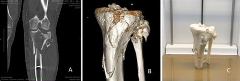 Tibial Plateau Fracture Shown In CT A 3D Reconstruction B And