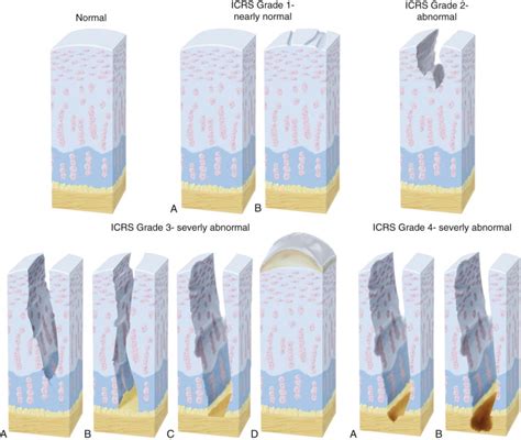 Articular Cartilage Lesion Musculoskeletal Key