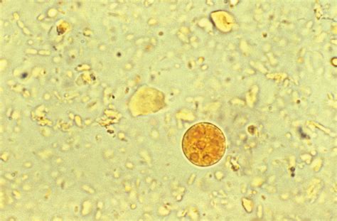 Entamoeba Histolytica Liver Abscess