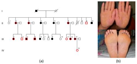 Ijms Free Full Text Palmoplantar Keratoderma A Molecular Genetic