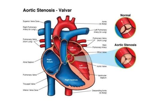 Left Ventricular Outflow Tract Obstruction