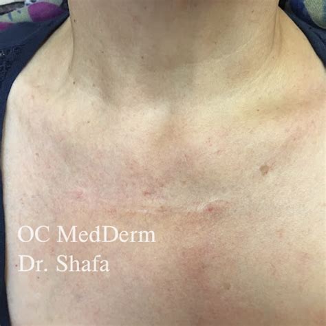 Keloid Treatment Irvine & Orange County, CA - OC MedDerm Dermatology