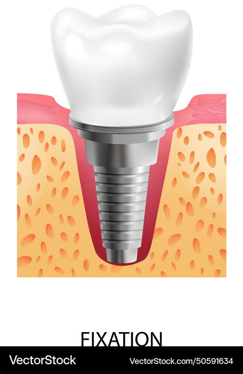 Dental Implantation Fixation Composition Vector Image