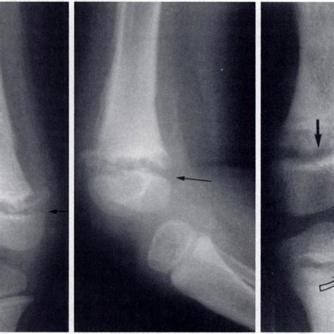 Physeal Fracture Anteroposterior A And Lateral B Radiographs Show