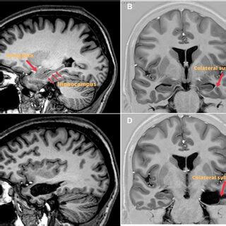 MRI (Coronal, axial and sagittal) pre and postoperative of surgery with ...