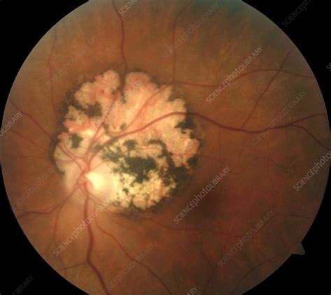 Toxoplasmosis Retina