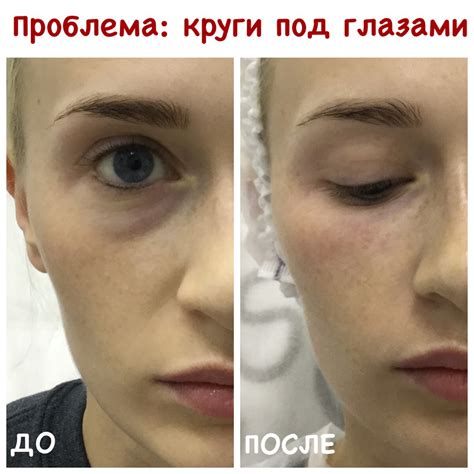 Филлеры Под Глаза До И После Фото — Mixyfotos.ru