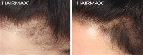 Before and After Plus Clinical Results Photos of Hair Growth– Hairmax