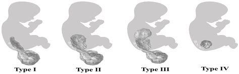 Immature Sacrococcygeal Teratoma: A Case Report and Extensive Review of
