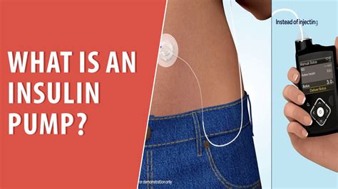 What Is An Insulin Pump?