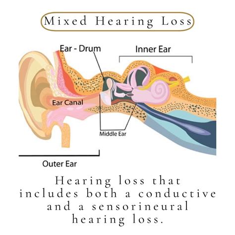 Conductive Hearing Loss Diagram