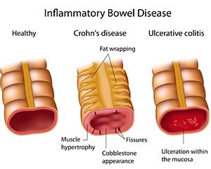 » Inflammatory Bowel Disease (IBD)