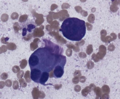 Biopsy Of Right Paratracheal Lymph Node Showing Large Loosely Cohesive