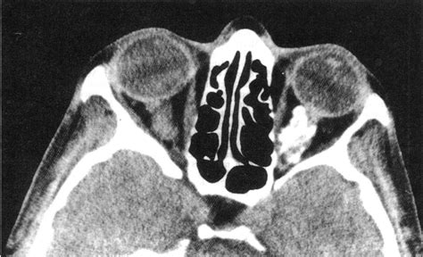 CT scan showing thickened calcified left optic nerve tumour and ...