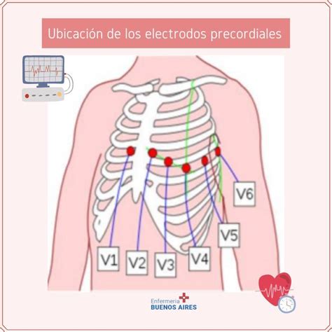 ¿cómo Colocar Correctamente Los Electrodos En El Paciente Y Monitorizar