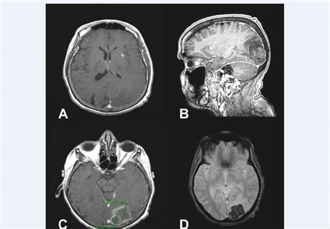 Mri Revealed Two Intracranial Lesions A Ca Mm Left Subinsular