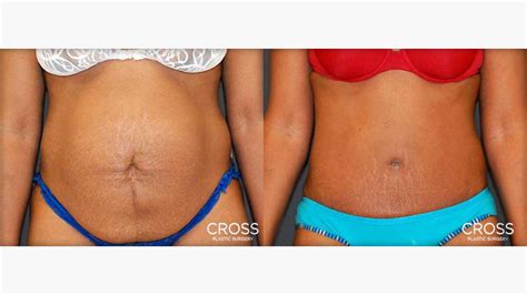 Tummy Tuck Recovery Time Photos Renew Physical Therapy