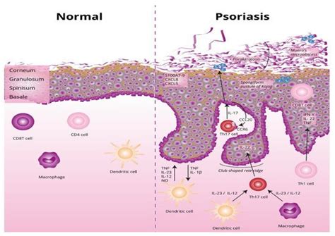 etiopathogenesis  psoriasis encyclopedia mdpi