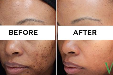 Black People Acne Scars Before And After