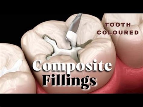 Composite Fillings Composite Filling Procedure Composite Bonding