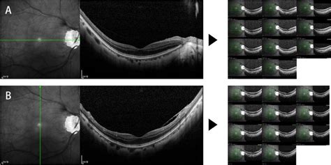 Examples Of Optical Coherence Tomography Oct Macular Scans For Which