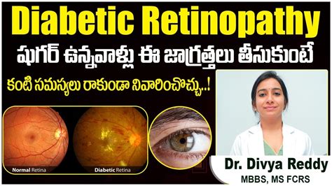 షుగర్ తో కంటి సమస్యలు Tips To Prevent Diabetic Retinopathy In Telugu Best Vision Eye