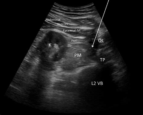 Psoas Muscle Ultrasound