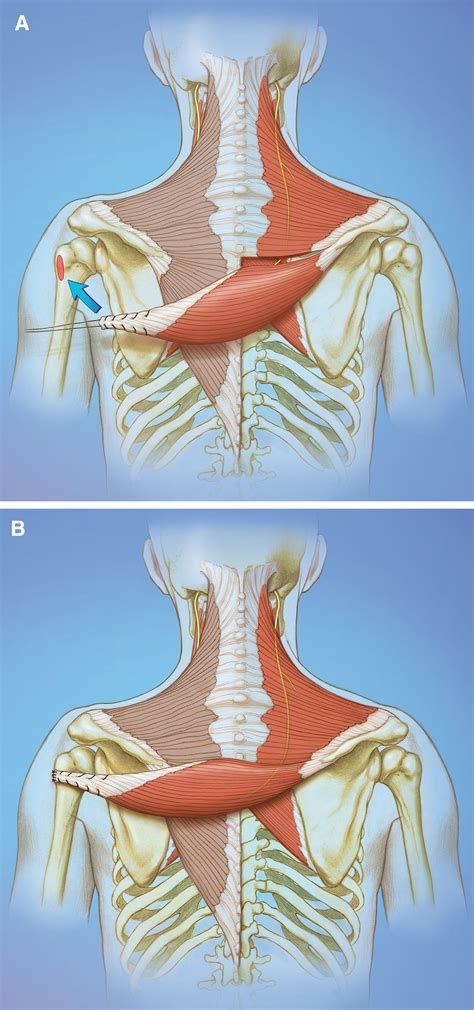 Trapezius Shoulder Abduction at Jett Embling blog