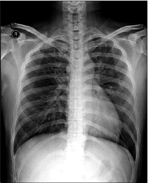 Pulmonary Edema X Ray