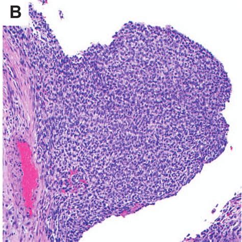 A frozen pelvis was encountered with significant hemorrhage, blood ...