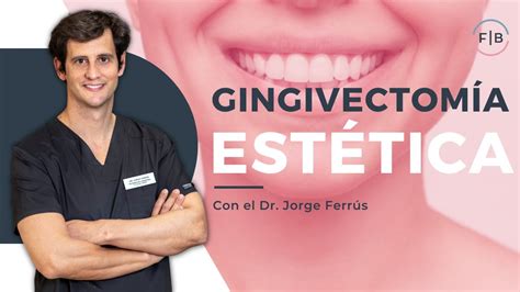 Gingivectom A Mejora La Est Tica De Tus Enc As Y Soluciona La Sonrisa