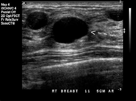 Simple cyst. Ultrasound image of a simple cyst in the breast (arrow).... | Download Scientific ...