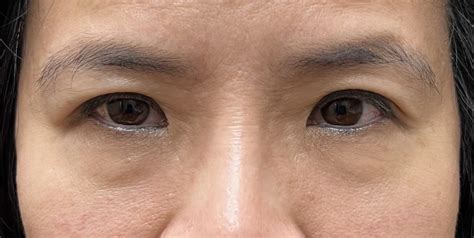 35 Eyelid Surgery Before And After Photos Dallas Plano Texas Cosmetic Reconstructive Eye Surgery