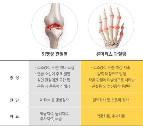 퇴행성 관절염의 원인과 초기증상 A8