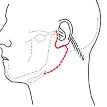 Pdf Partial Superficial Parotidectomy Via Retroauricular Hairline