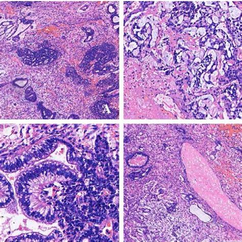 Histology Of The Mixed Germ Cell Tumor A Low Power Photomicrograph Download Scientific