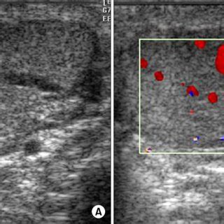 Gray Scale And Color Doppler Ultrasound A Gray Scale Ultrasound