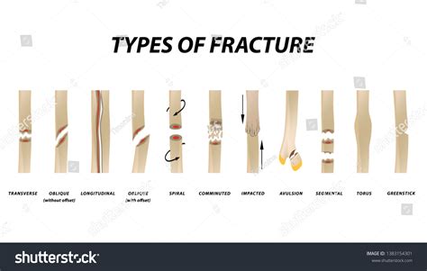 957 Types of fracture Stock Vectors, Images & Vector Art | Shutterstock