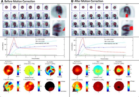 Data Driven Motion Correction Rescues Interpretation Of Rubidium Pet