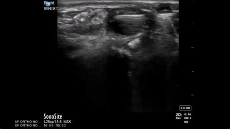 Wrist Ultrasound Ganglion Cyst Aspiration And Injection Youtube