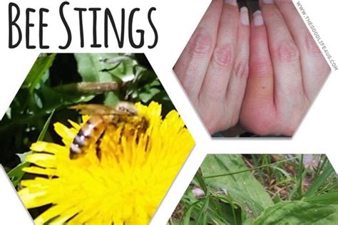 How To Treat Bee Stings Home Remedy Treating Bee Stings Bee Sting