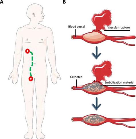 Post-Biopsy Complications Associated with Percutaneous Kidney Biopsy ...