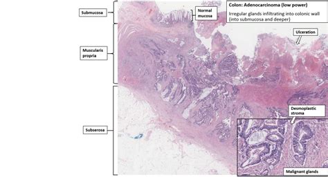 Colon Adenocarcinoma NUS Pathweb NUS Pathweb